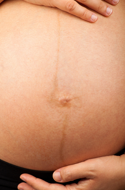 Image of linea nigra